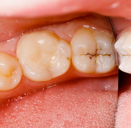 Tooth Decay Pakenham