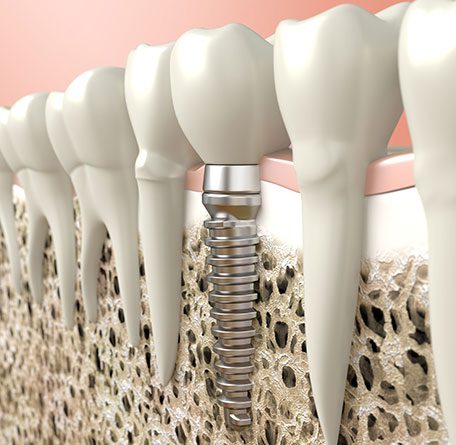 Dental Implant gallery